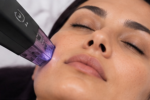 Morpheus8 skin rejuvenation treatment