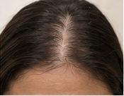 Emerging and Regenerative Hair Restoration Options