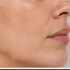 Skin pore and texture treatment