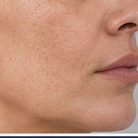 Fine lines skin treatment