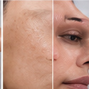 Vascular laser treatment