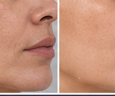 Skin tightening and rejuvenation treatment