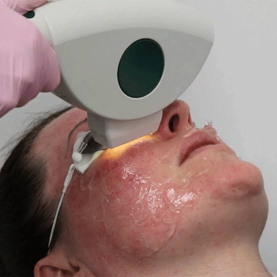 Pigmentation and vascular treatment recovery