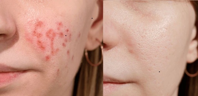 Laser Tattoo Removal and Erbium Resurfacing treatment