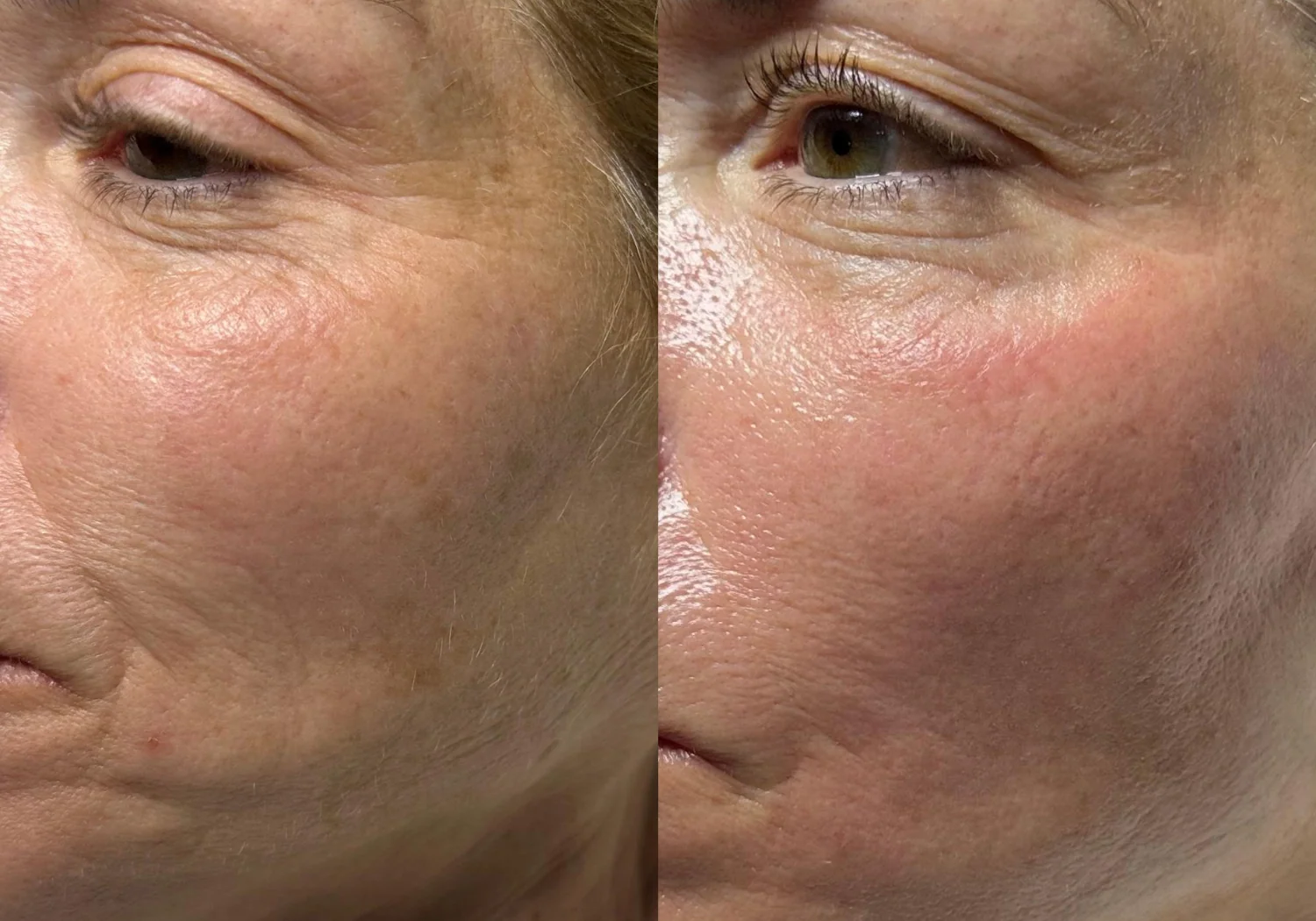 HydraFacial patient result before and after 01