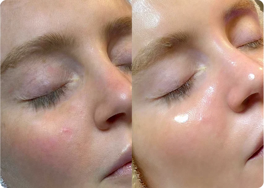 HydraFacial patient result before and after 02