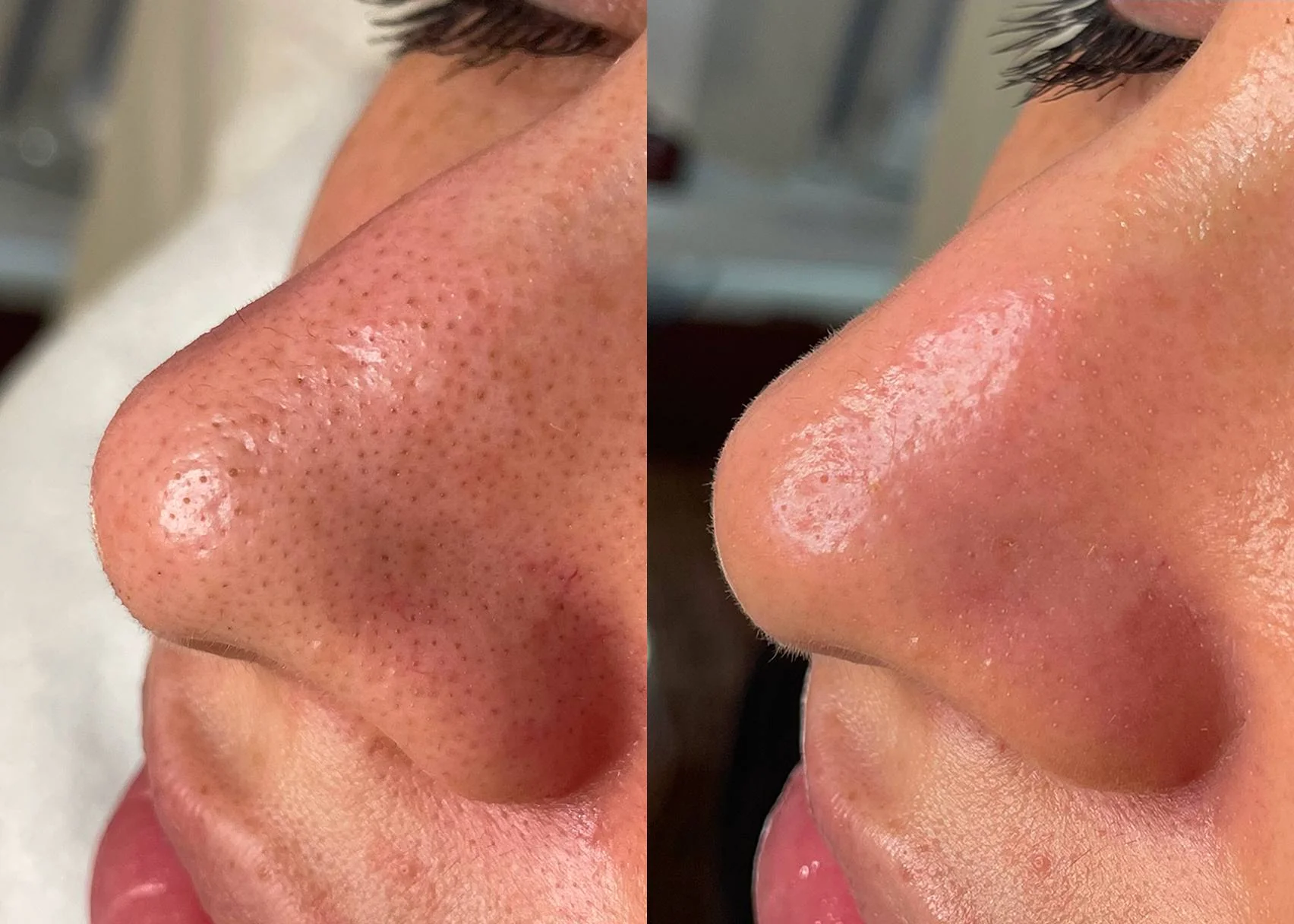 HydraFacial patient result before and after 03
