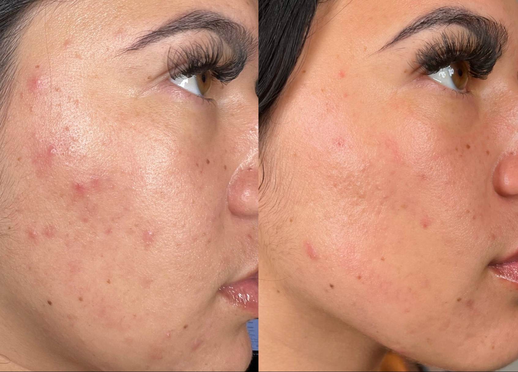 HydraFacial patient result before and after 04