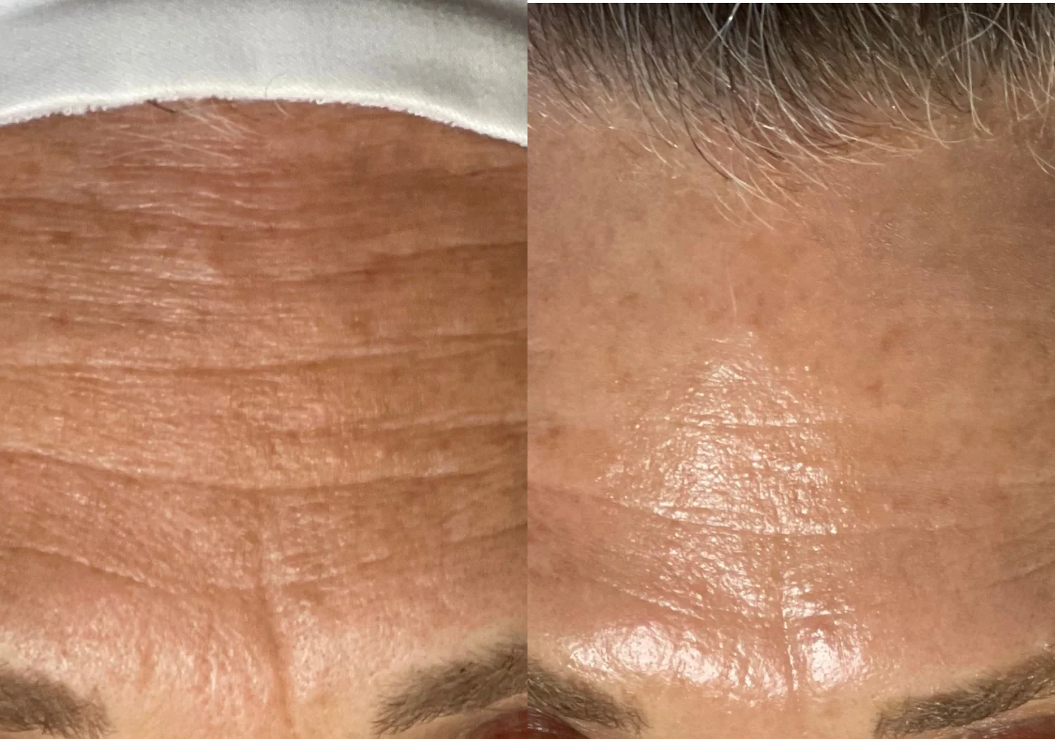 HydraFacial patient result before and after 05