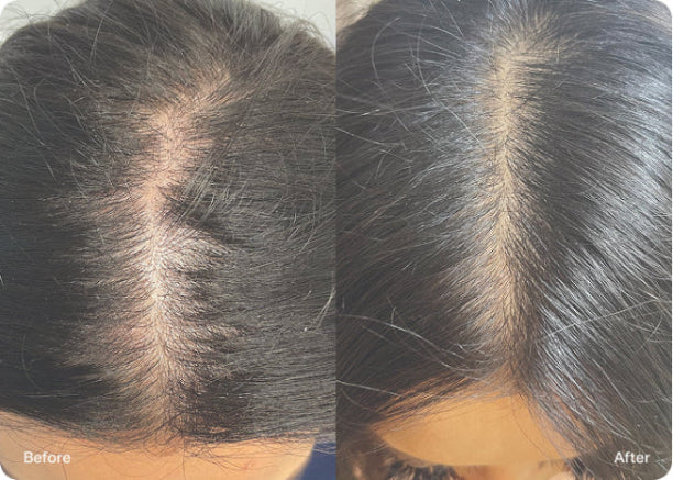 HydraScalp before and after result