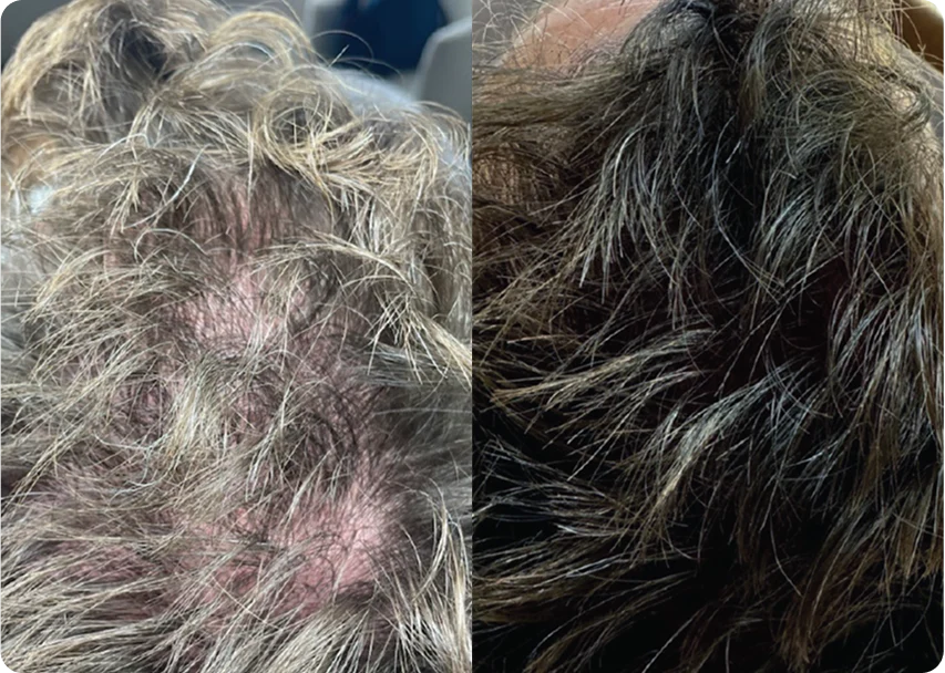 HydraScalp before and after result