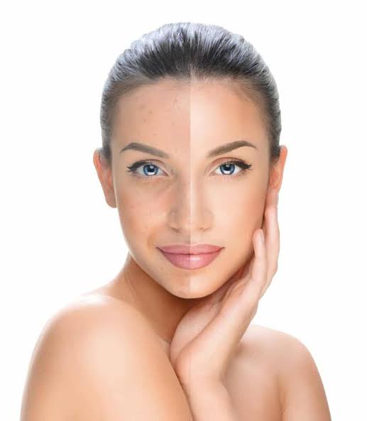 Youthology chemical peel treatment