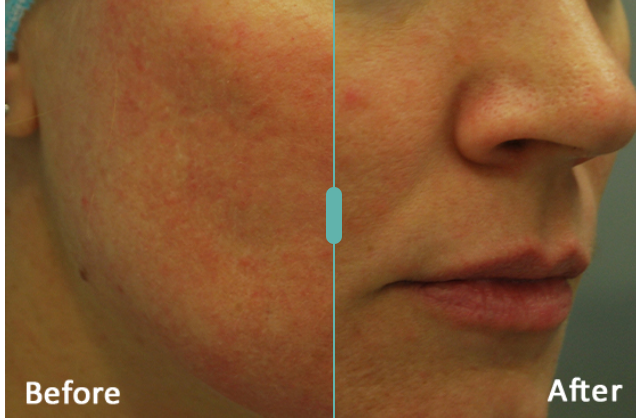 Morpheus8 Before and After Result 1