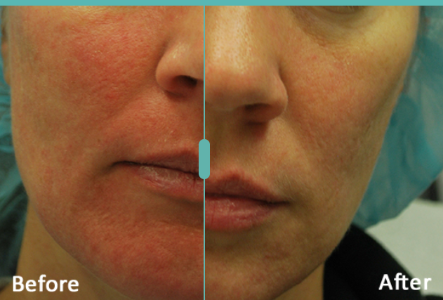 Morpheus8 Before and After Result 2