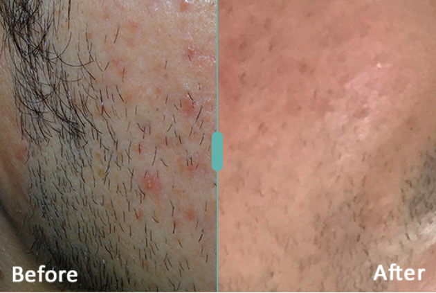 Morpheus8 Before and After Result 3