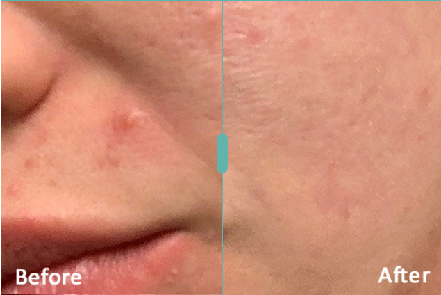 Morpheus8 Before and After Result 4