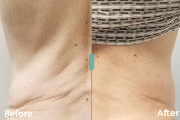 Morpheus8 Before and After Result 5